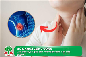 Ung Thư Tuyến Giáp: Ảnh Hưởng Thế Nào Đến Sức Khỏe?